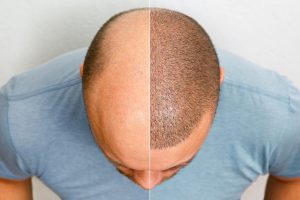 השתלת שיער לגברים לפני ואחרי
