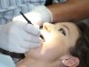 לומינייט או לומינרס – כל מה שצריך לדעת לפני שבוחרים ציפוי לשיניים